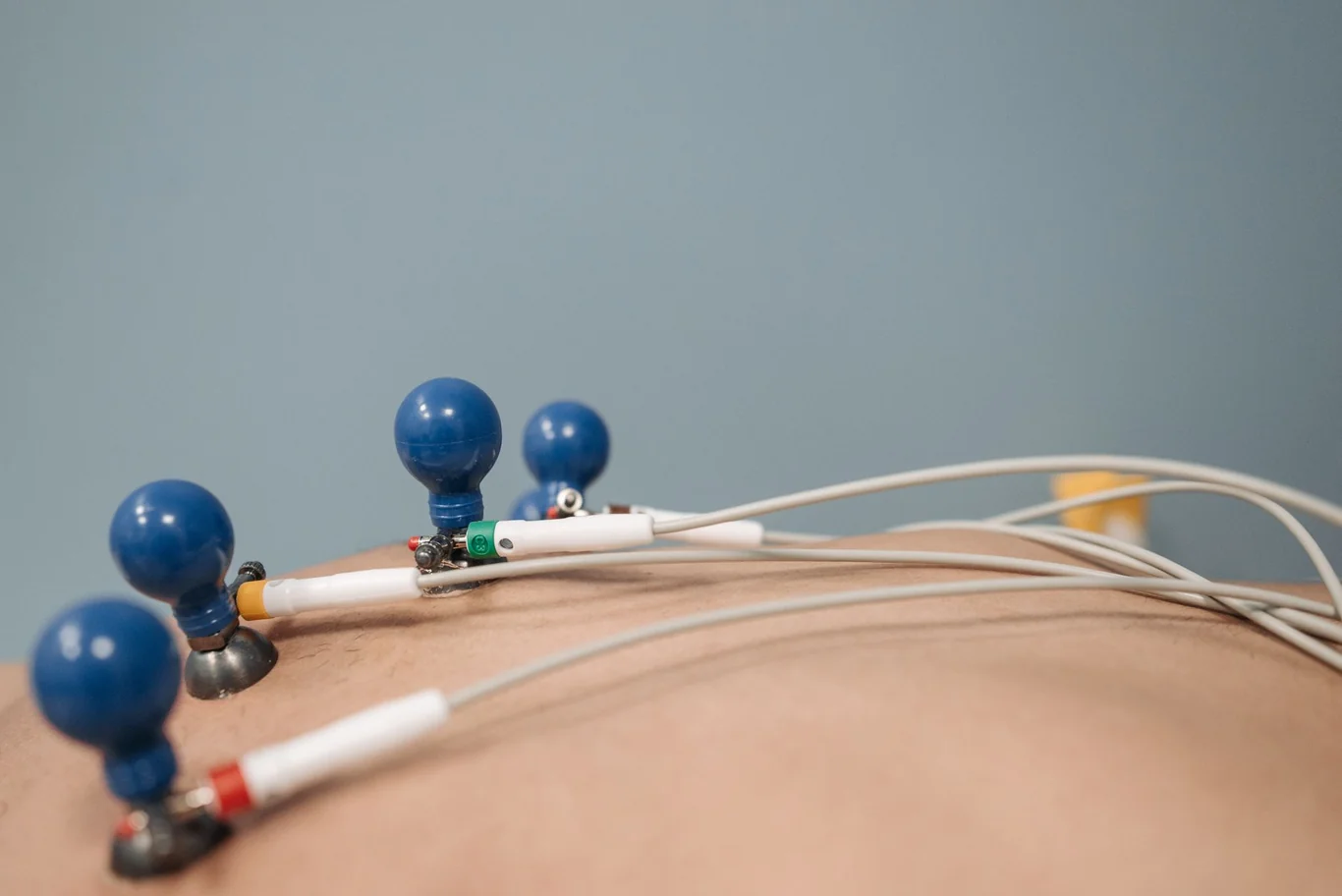 ECG electrode sensors with suction cups attached to a person's bare chest, showing electrical contact points